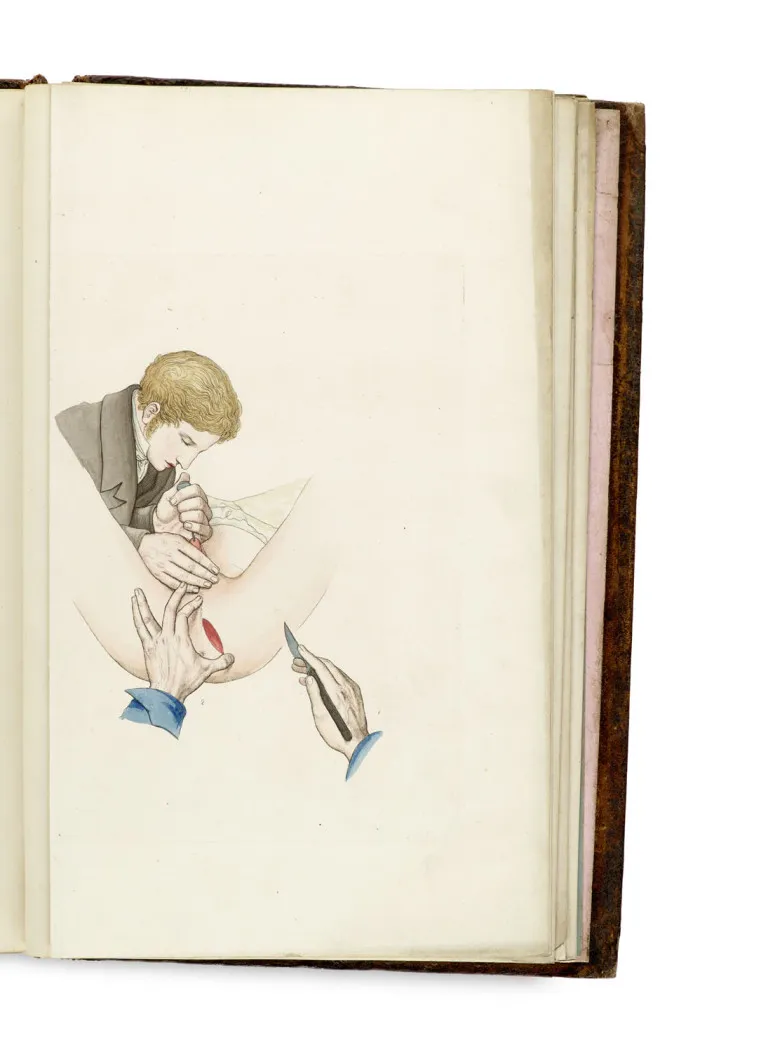 Vincenz von Kern – Bladder stones, their related ailments, and lithotomy in both sexes