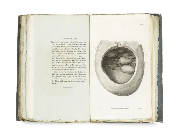 Alexander Marcet – Essai d'une histoire chimique et d'un traitement médical des maladies calculeuses