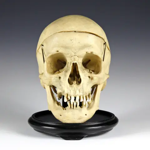 Medicine & Pharmacy – Anatomisches Präparat eines menschlichen Schädels. Lehrmodell, um 1880, Schädeldecke abnehmbar, Unterkiefer…