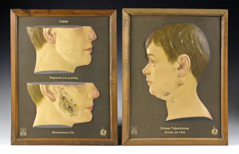 Medicine & Pharmacy – Zwei anatomische Lehrtafeln des Deutschen Hygienemuseums. Dresden, um 1930, Rachitis und Drüsentuberkulose, geprägte…